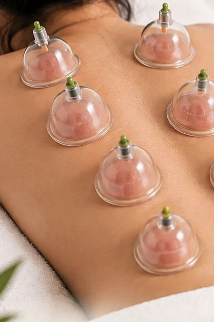 Ventosas terapéuticas aplicadas sobre la espalda